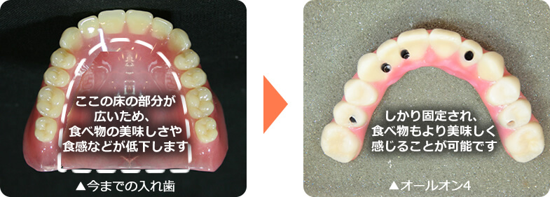 オールオン4と入れ歯比較