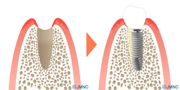抜歯即時インプラント