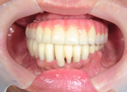 CASE03 All on 4