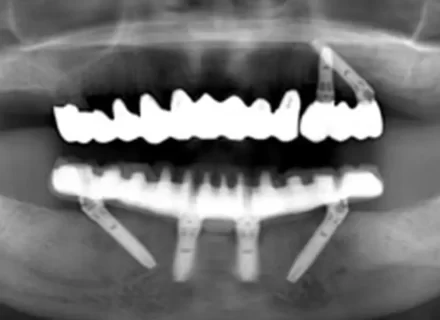CASE09 All on 4