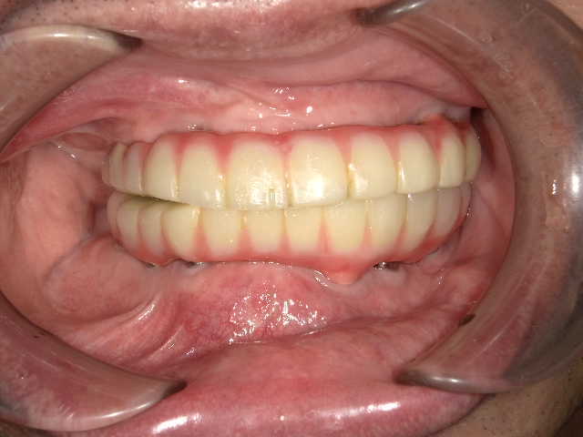 治療後3年経過時点