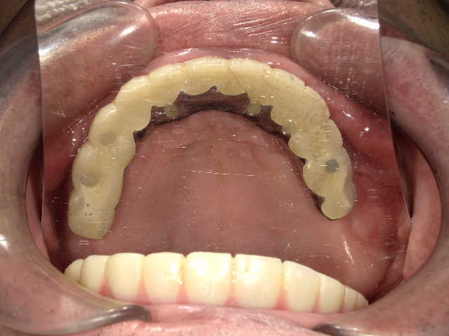 治療後3年経過時点