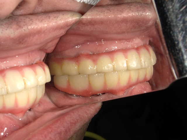 治療後3年経過時点