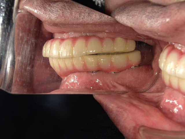 治療後3年経過時点